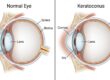 keratconus